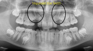 Impacted teeth