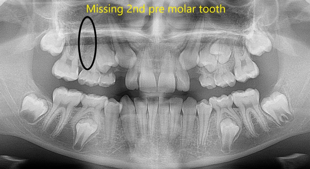 Missing tooth