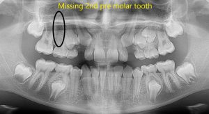 Missing tooth