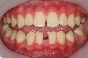 teeth spacing