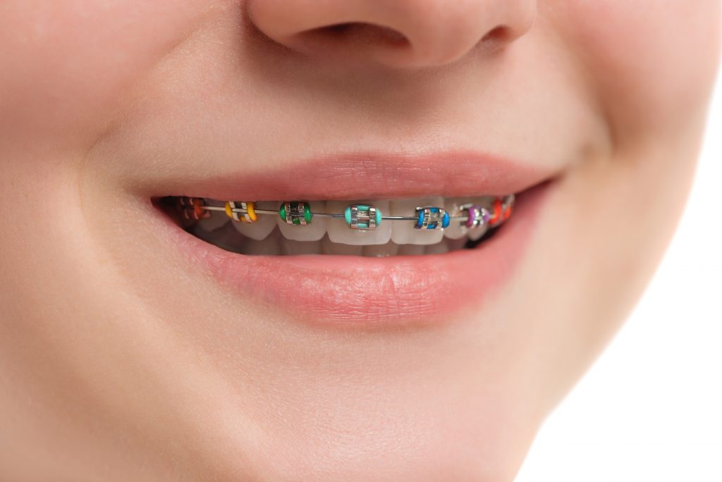 Closeup multicolored Braces on Teeth. Beautiful Female Smile with Self-ligating Braces. Orthodontic Treatment.